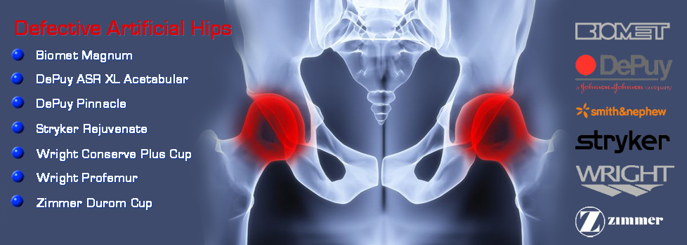 Alabama DePuy Pinnacle Hip Implant Lawyers - Johnson and Johnson's DePuy Pinnacle hip implant is a metal-on-metal device causing severe discomfort to many of its recipients.  Call us if you have one of these devices and are experiencing problems.