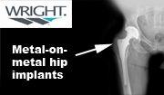 Alabama Wright Conserve Hip Replacement Recall Lawyer